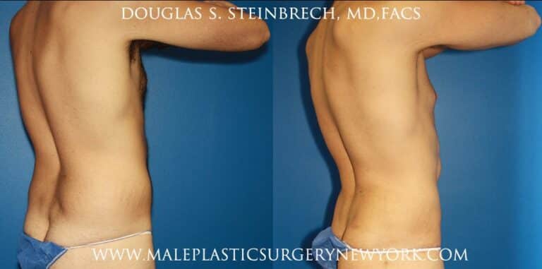 Torso tuck and liposuction for body sculpting by Dr. Steinbrech