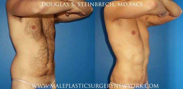 Torso tuck and liposuction for body sculpting by Dr. Steinbrech