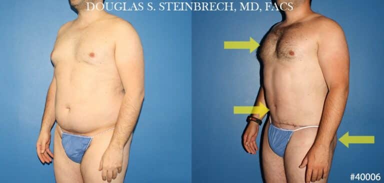 Torso tuck with body banking to reduce midsection by Dr. Steinbrech