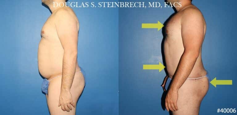 Torso tuck with body banking to reduce midsection by Dr. Steinbrech