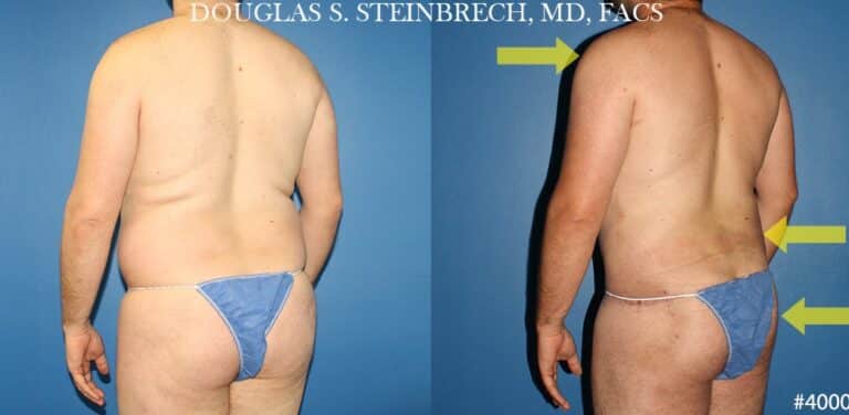 Torso tuck with body banking to reduce midsection by Dr. Steinbrech