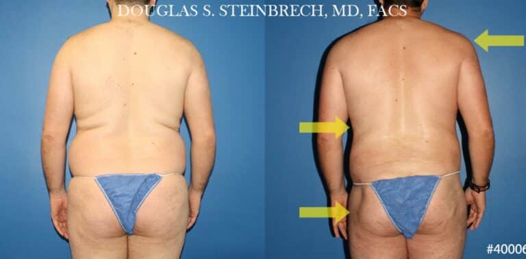 Torso tuck with body banking to reduce midsection by Dr. Steinbrech