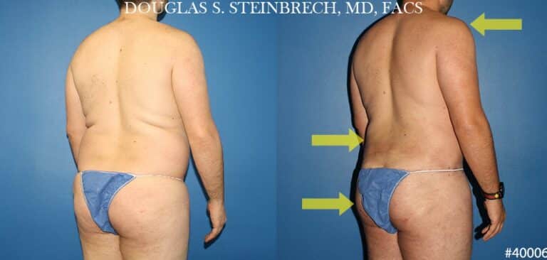 Torso tuck with body banking to reduce midsection by Dr. Steinbrech