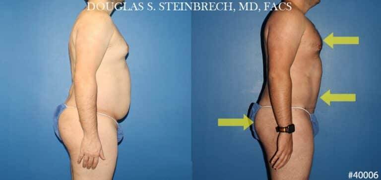 Torso tuck with body banking to reduce midsection by Dr. Steinbrech