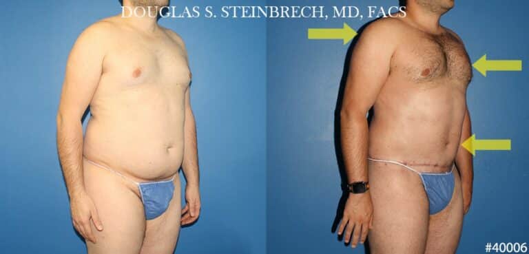 Torso tuck with body banking to reduce midsection by Dr. Steinbrech