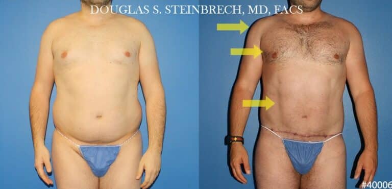 Torso tuck with body banking to reduce midsection by Dr. Steinbrech