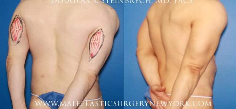 Tricep implants for upper arm augmentation by Dr. Steinbrech