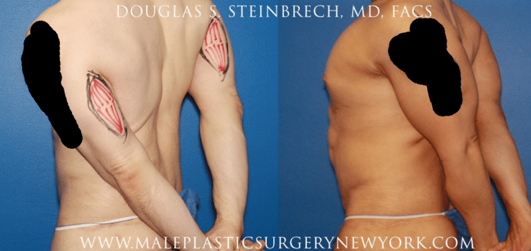 Tricep implants for upper arm augmentation by Dr. Steinbrech