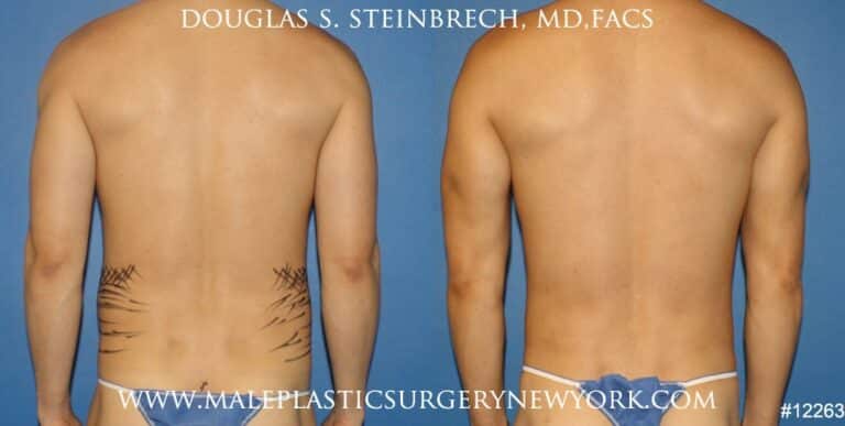 Body banking to create surfer abs and sculpt the back and waistline by Dr. Steinbrech