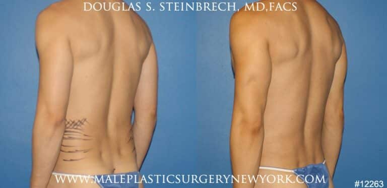 Body banking to create surfer abs and sculpt the back and waistline by Dr. Steinbrech