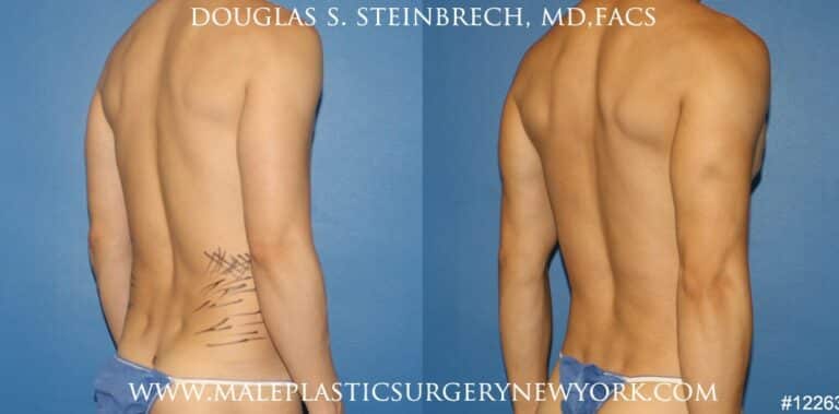 Body banking to create surfer abs and sculpt the back and waistline by Dr. Steinbrech