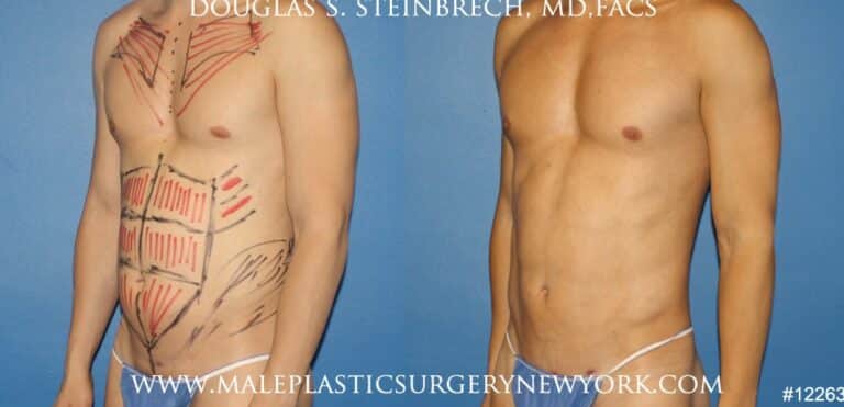 Body banking to create surfer abs and sculpt the upper body by Dr. Steinbrech