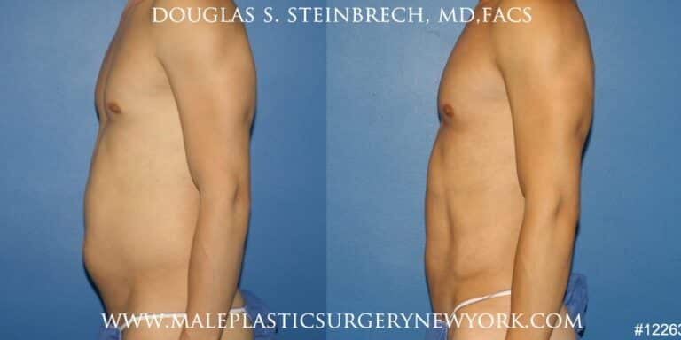 Body banking to create surfer abs and sculpt the upper body by Dr. Steinbrech