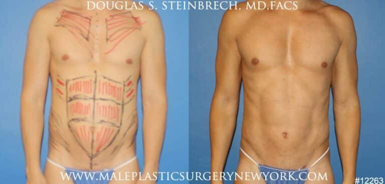 Body banking to create surfer abs and sculpt the upper body by Dr. Steinbrech