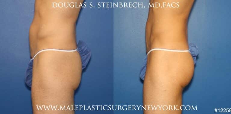Gluteal implants for buttock enhancement by Dr. Steinbrech