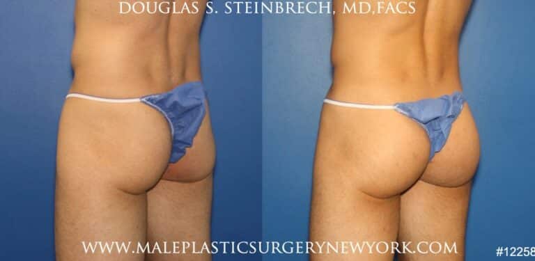 Gluteal implants for buttock enhancement by Dr. Steinbrech