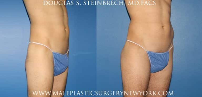 Gluteal implants for buttock augmentation by Dr. Steinbrech