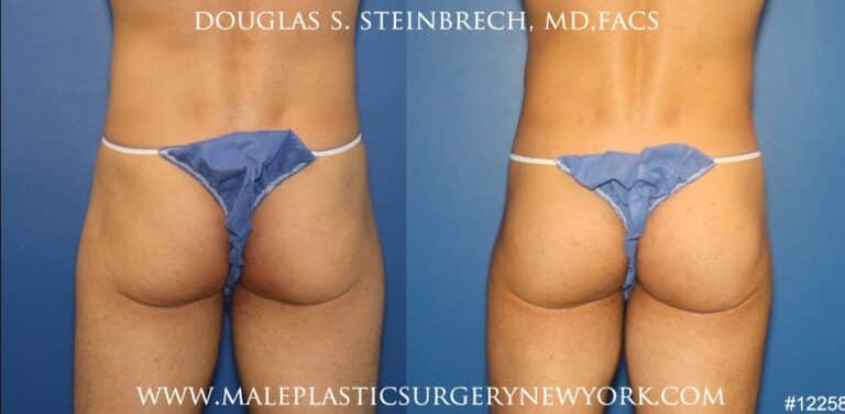 Gluteal implants for buttock enhancement by Dr. Steinbrech