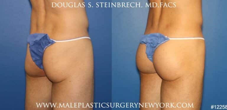 Gluteal implants for buttock enhancement by Dr. Steinbrech