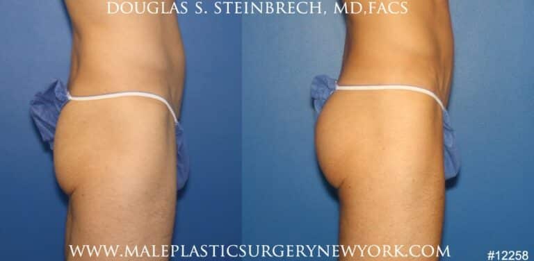 Gluteal implants for buttock enhancement by Dr. Steinbrech