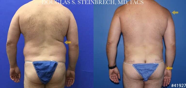 270 Torso tuck with body banking for contouring by Dr. Steinbrech