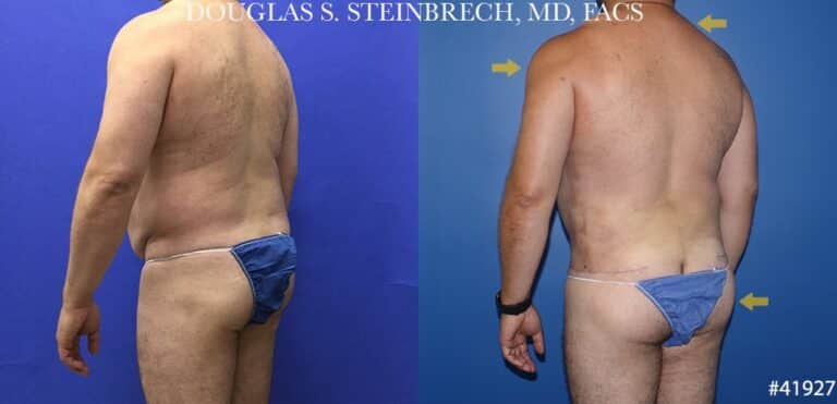 270 Torso tuck with body banking for contouring by Dr. Steinbrech