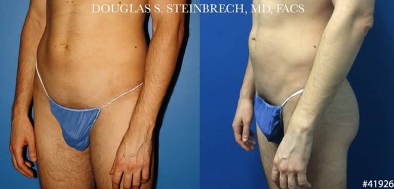Gluteal implants for buttock augmentation by Dr. Steinbrech