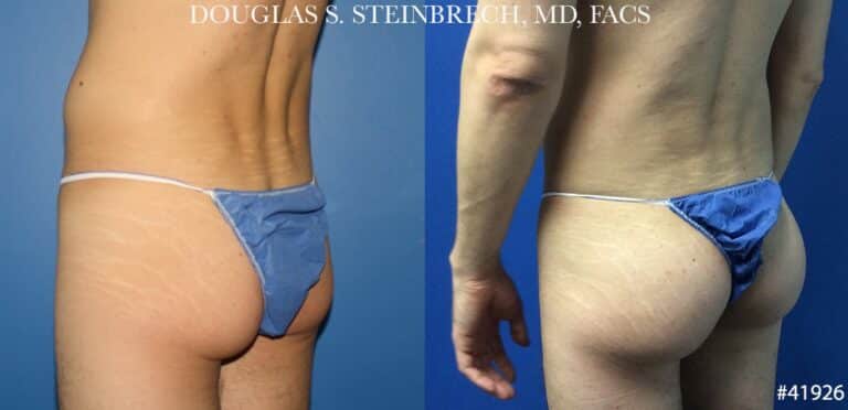 Gluteal implants for buttock augmentation by Dr. Steinbrech