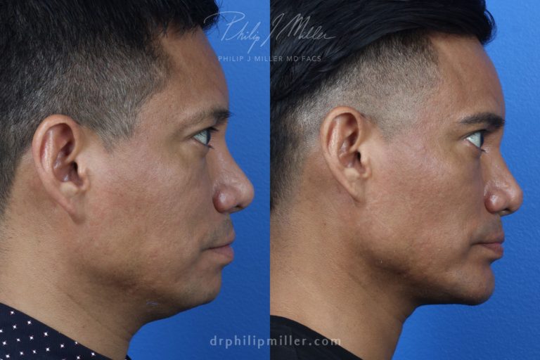 Neck-Tite and Liposuction to Contour the Neck by Dr. Miller
