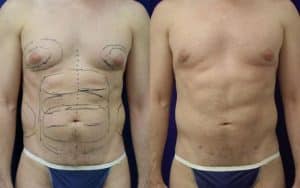 5 Reasons to Consider Liposuction: Cosmetic Surgery Center: Cosmetic  Surgeons