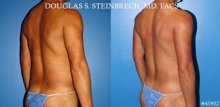 Body banking with fat transfer to the pecs and shoulders by Dr. Steinbrech