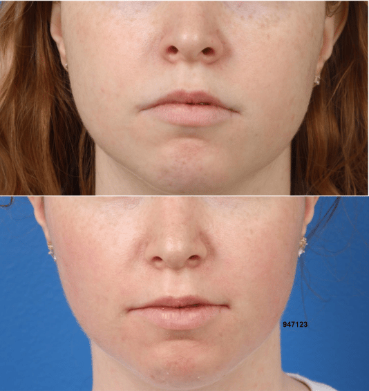 The Difference Between Buccal Fat Pad Removal and Cheek Liposuction: Which  One Is Right For Me? - CENTER for Advanced Facial Plastic Surgery