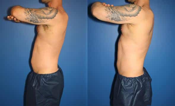 Coolsculpting  Permanent Body Contouring