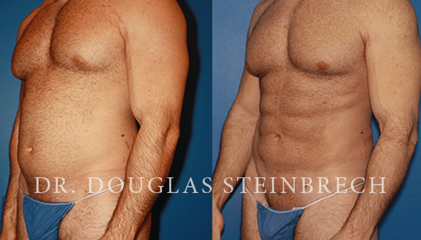 Liposuction - series—Aftercare: MedlinePlus Medical Encyclopedia