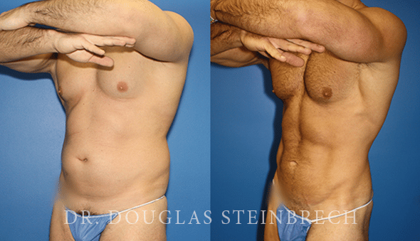 Liposuction Surgeon New York City