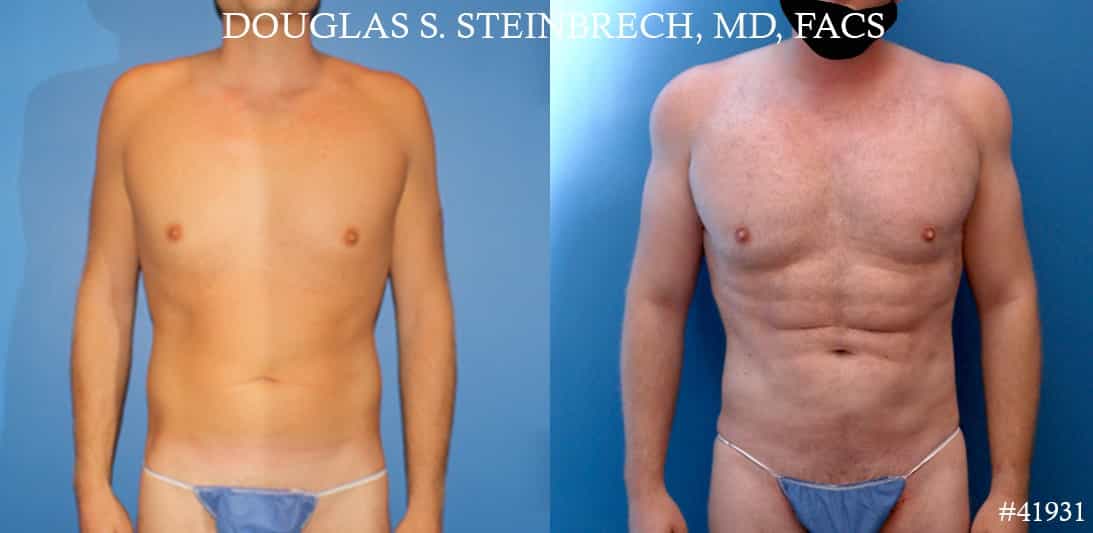 Abdomen Liposuction  Dr. York Yates Plastic Surgery