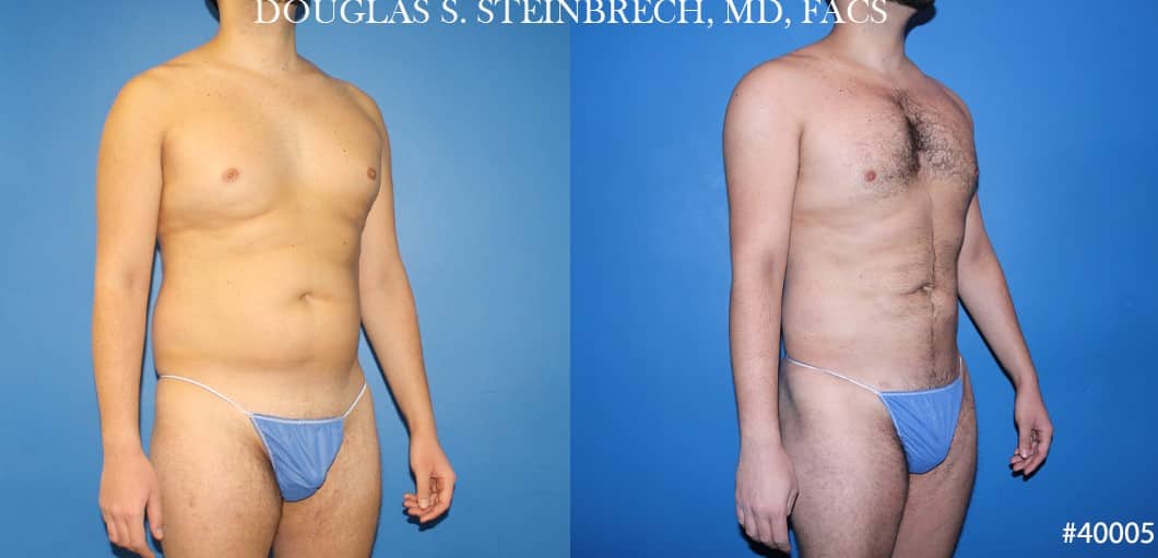 Liposuction Surgeon New York City