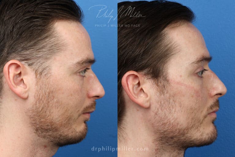 Chin implant to strengthen chin by Dr. Miller