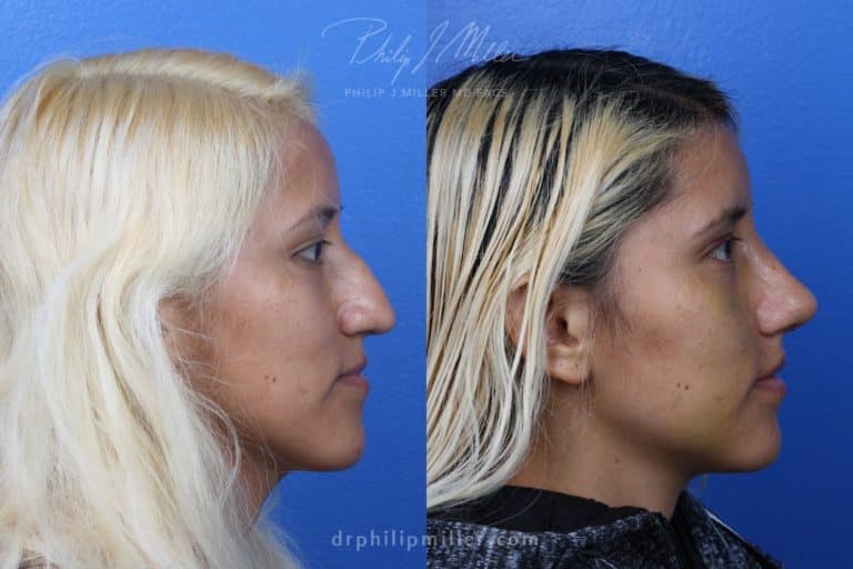 Rhinoplasty to remove hump from nasal bridge by Dr. Miller