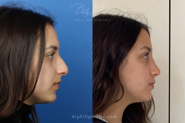 Rhinoplasty to straighten bridge and refine nasal tip by Dr. Miller
