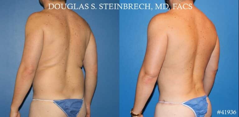 Body banking, fat transfer to shoulder and pecs by Dr. Steinbrech