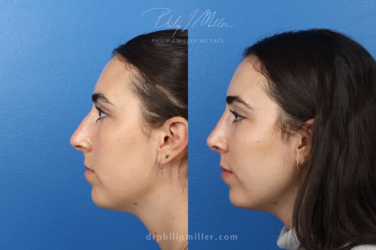 Rhinoplasty to improve nasal bridge and tip, 3 month post-op, by Dr. Miller