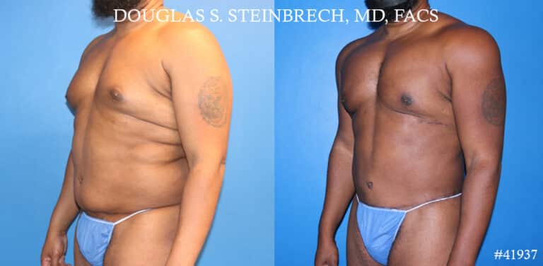 Liposuction and body banking to sculpt torso by Dr. Steinbrech