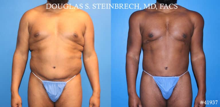 Liposuction and body banking to sculpt torso by Dr. Steinbrech