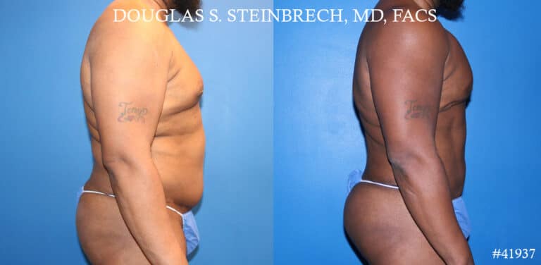 Liposuction and body banking to sculpt torso by Dr. Steinbrech