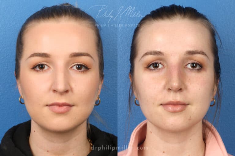 Rhinoplasty to remove hump from nasal bridge, one week later, by Dr. Miller