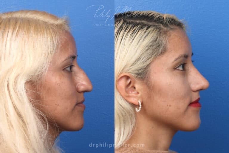 Rhinoplasty to remove hump from nasal bridge – 3 months post-op – by Dr. Miller