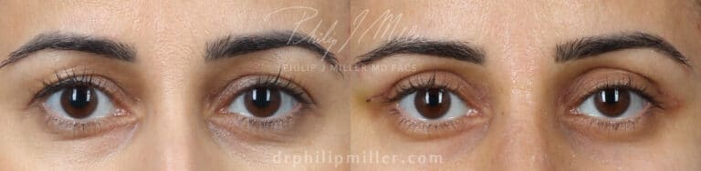 Upper blepharoplasty to treat eyelid hooding by Dr. Miller