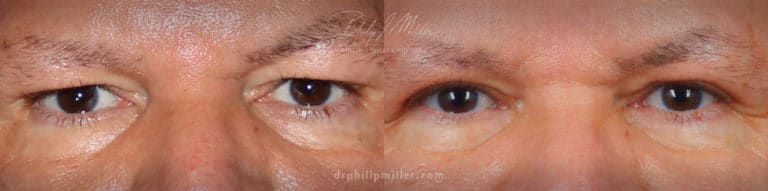 Upper blepharoplasty to treat eyelid hooding by Dr. Miller