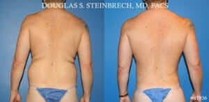 The Anatomy Basis of Aesthetic Iliac Crest Reduction - Explore Plastic  Surgery